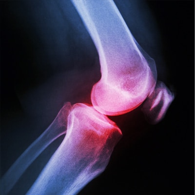 Osteolysis is observed around both bioabsorbable and nonabsorbable ...