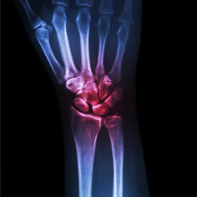 Osteolysis is observed around both bioabsorbable and nonabsorbable ...